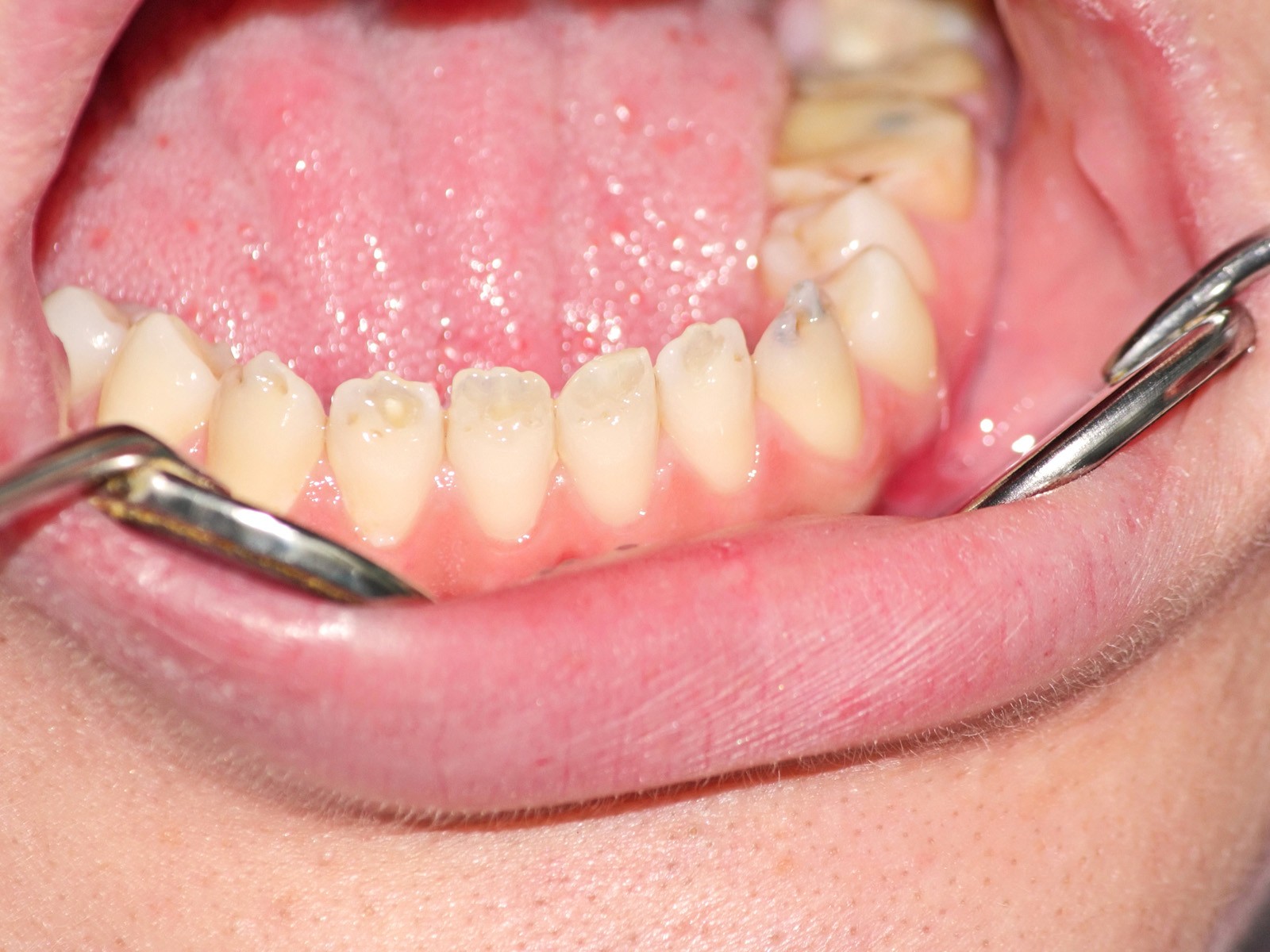 Teeth Staining Explained!