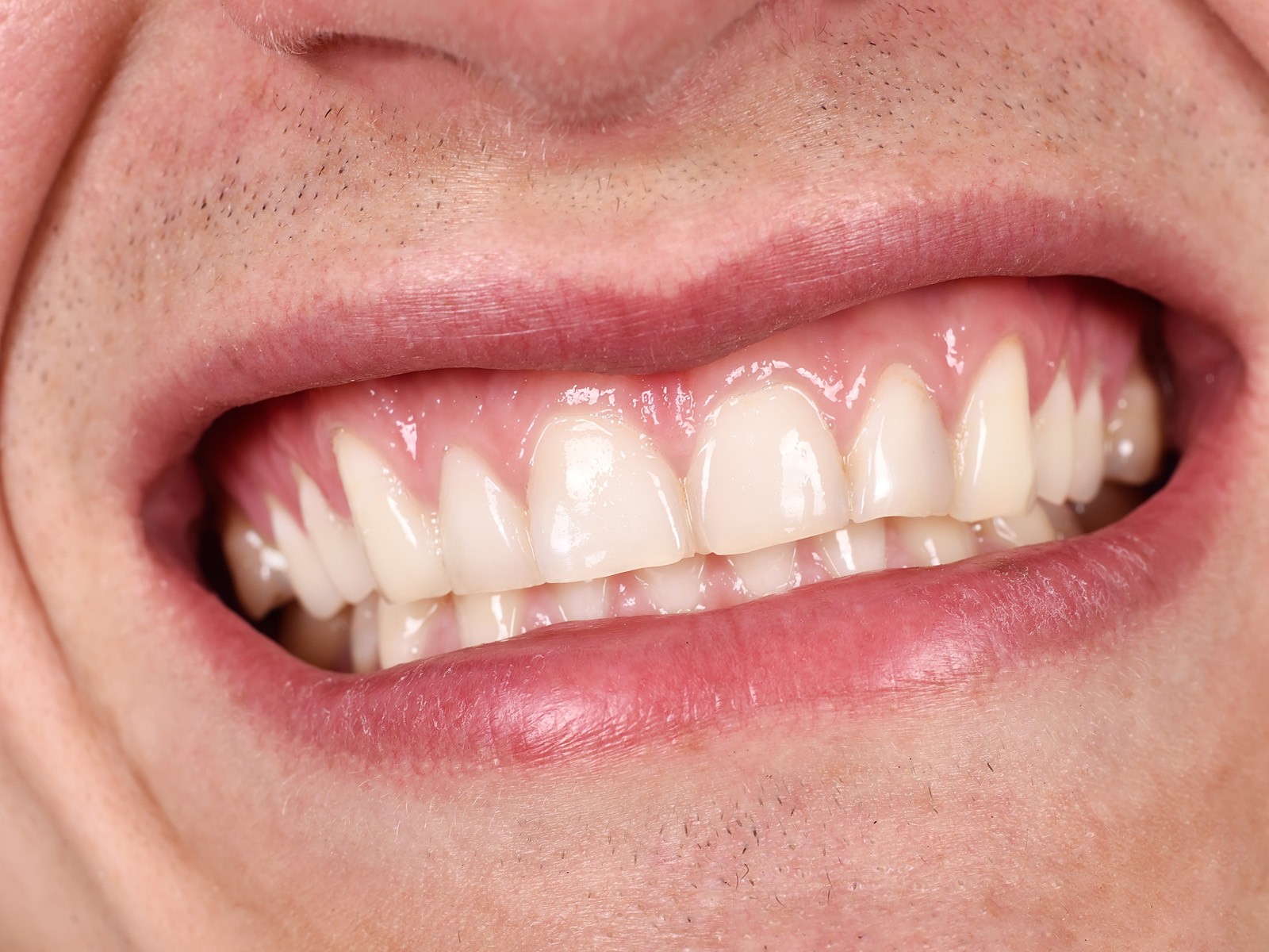 Top Advantages Of Having Straight Teeth