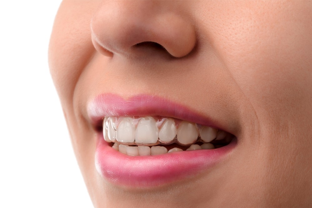 How Are Invisalign Aligners Made