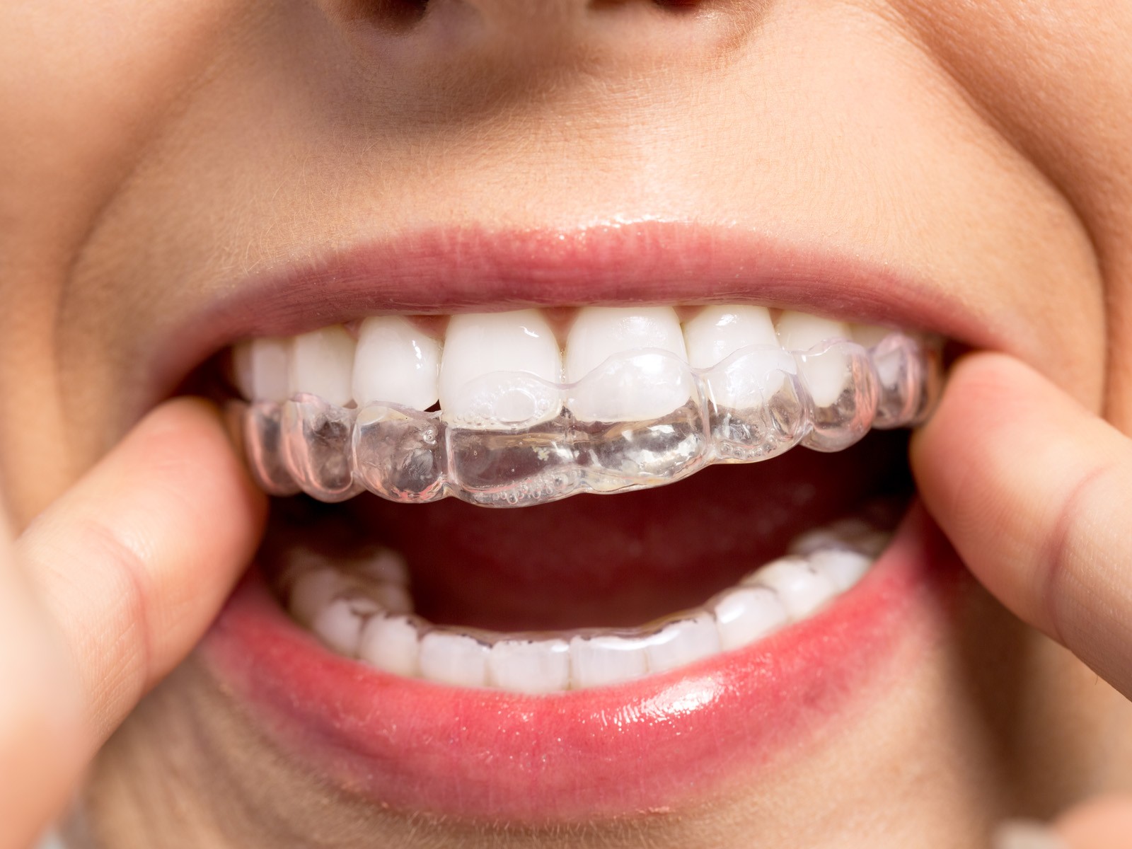 When to Use Invisalign