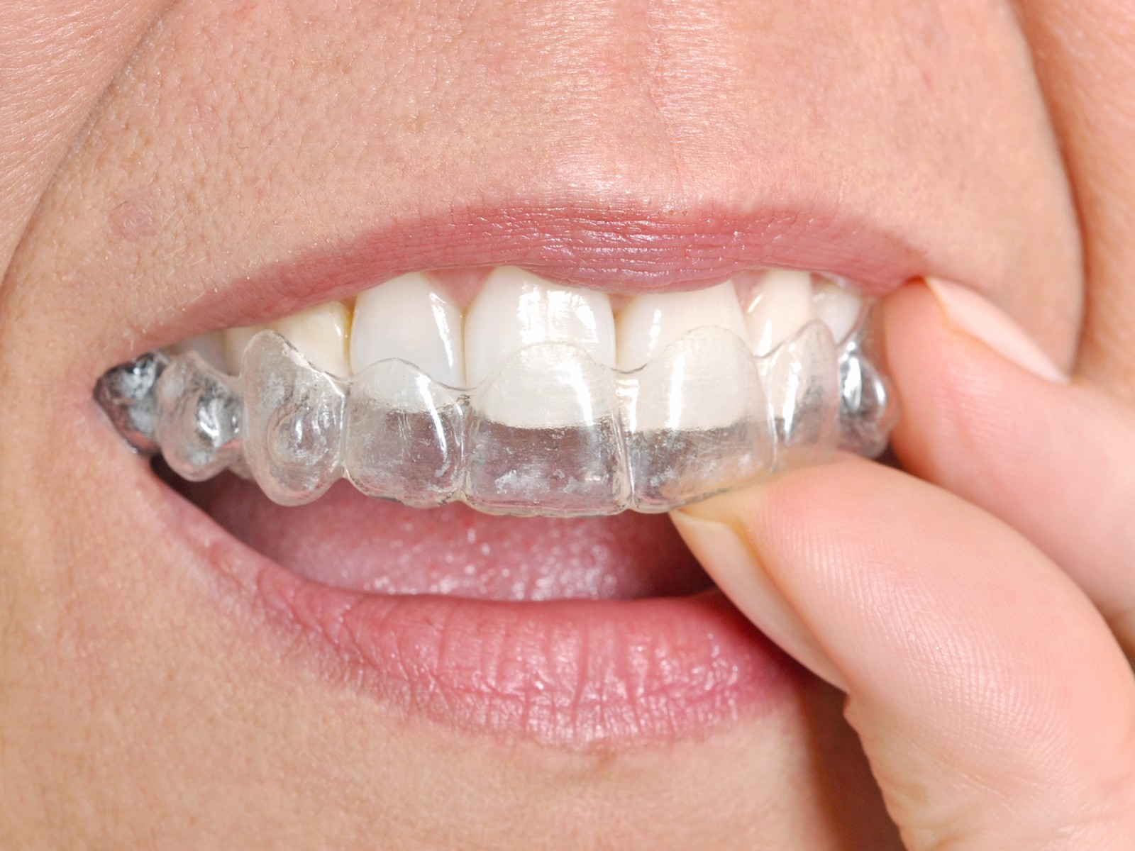 Why is Invisalign so slow?