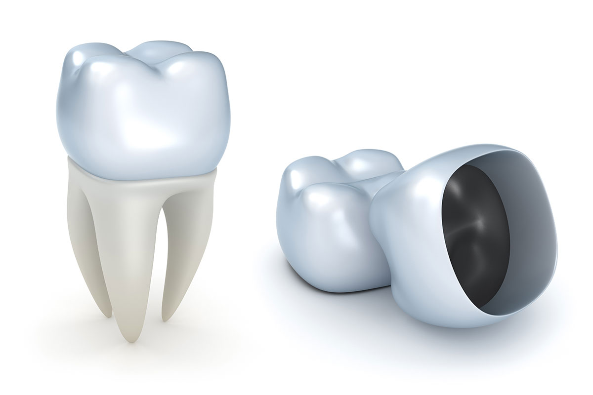 Same day digital dentistry with CEREC. The patient had a root canal in the  tooth and a temporary filling in addition to the tooth b…