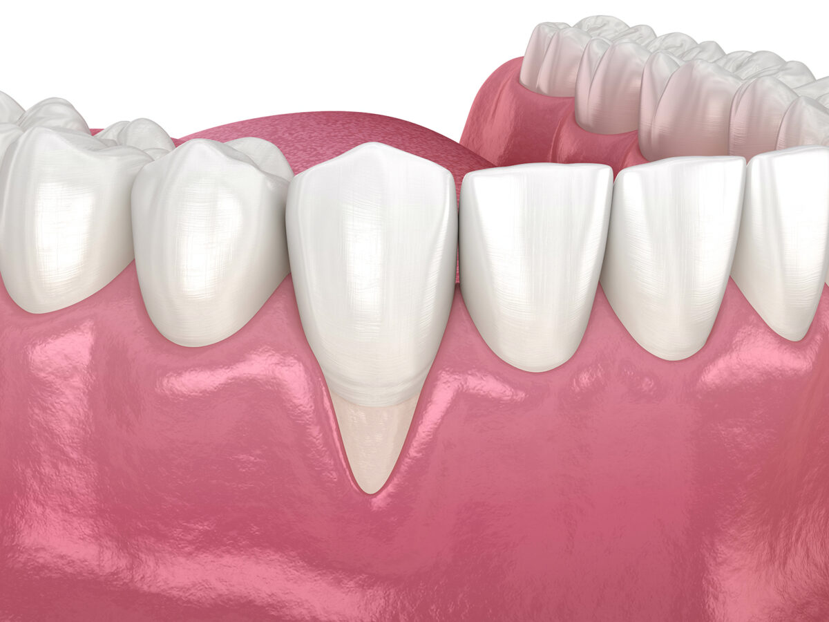 What Causes Gum Recession?