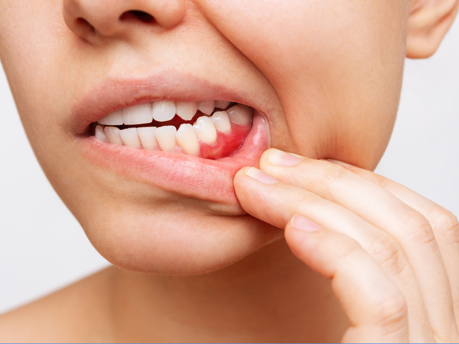 What Causes Dental Cysts on Gums?
