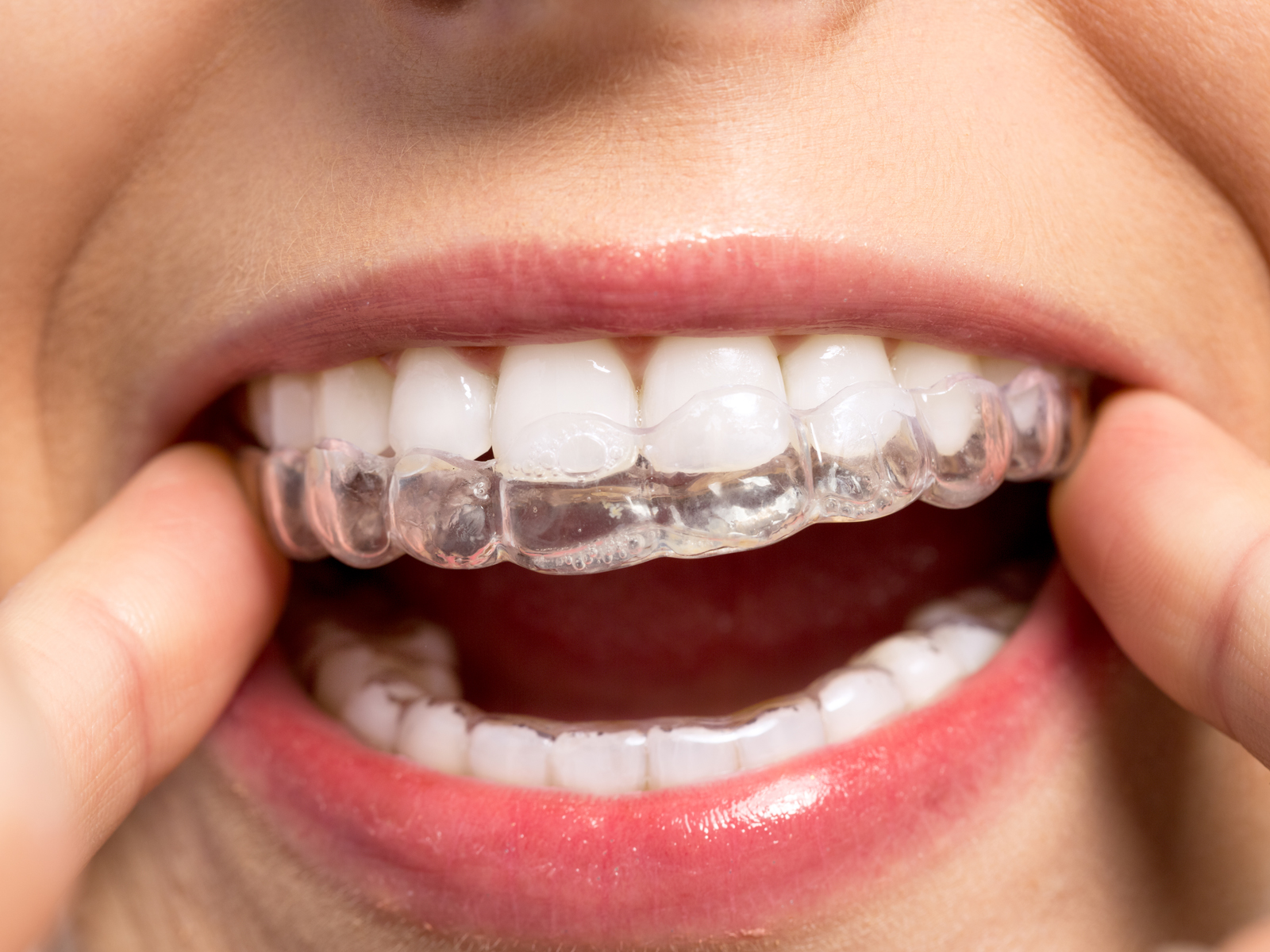 Is Invisalign The Best Solution For Underbite Treatment?