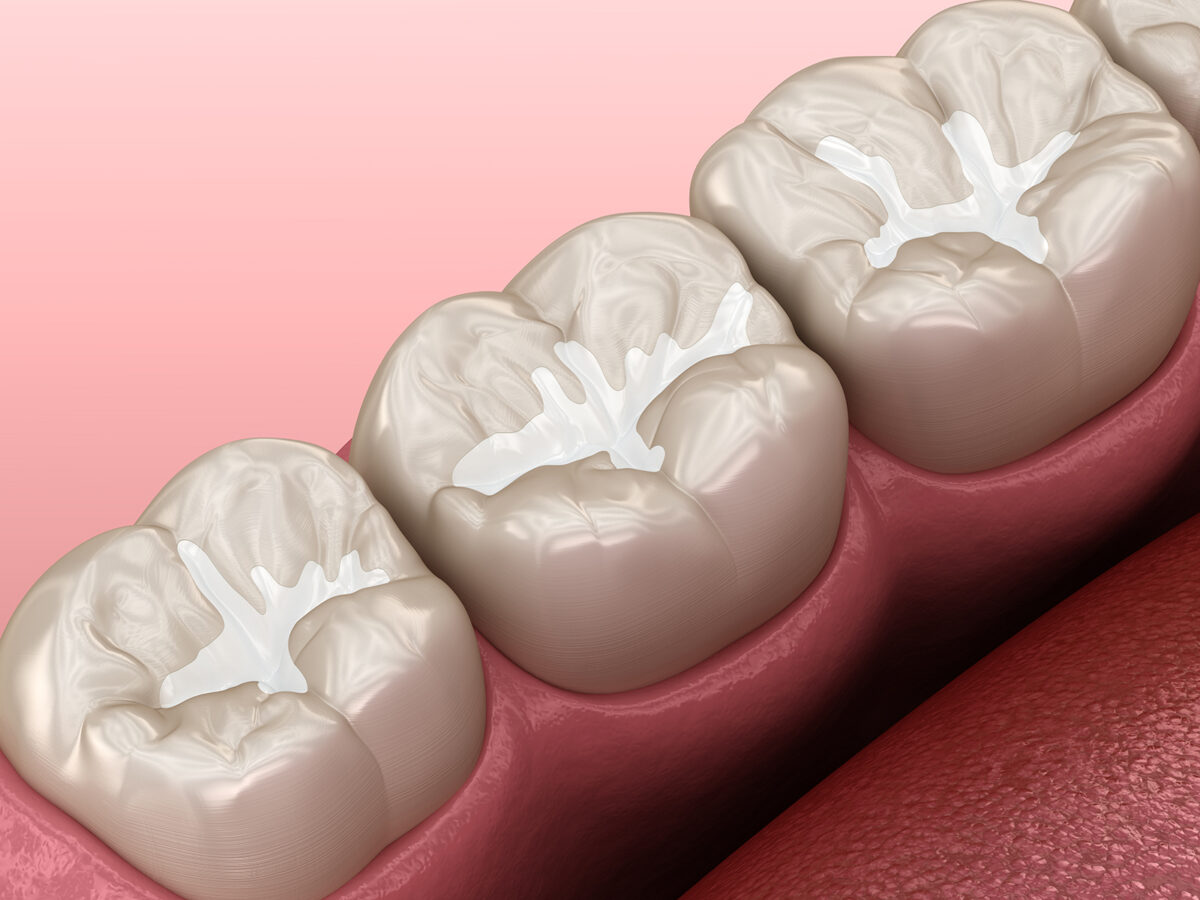 How Do You Take Care of Dental Sealants?