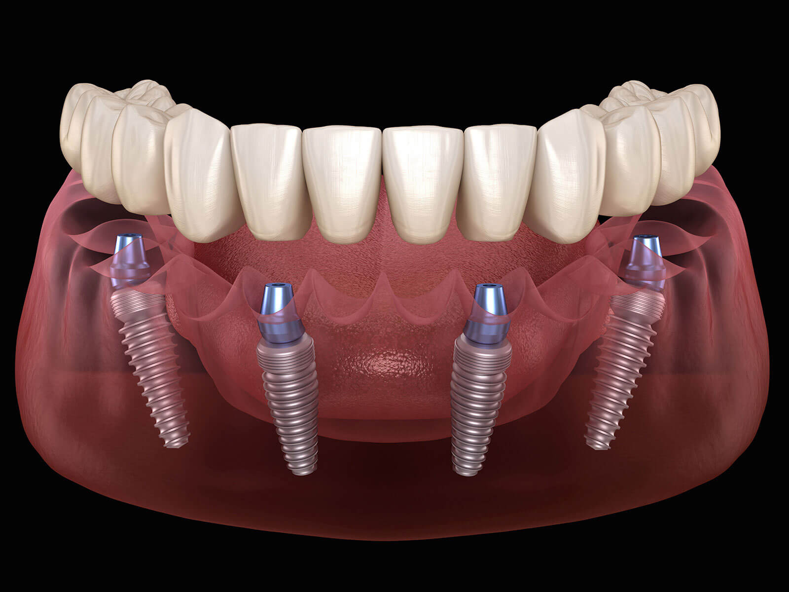 Benefits of All-On-4 Dental Implants