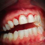 Common Bleeding Gum Causes & How You Can Prevent Them