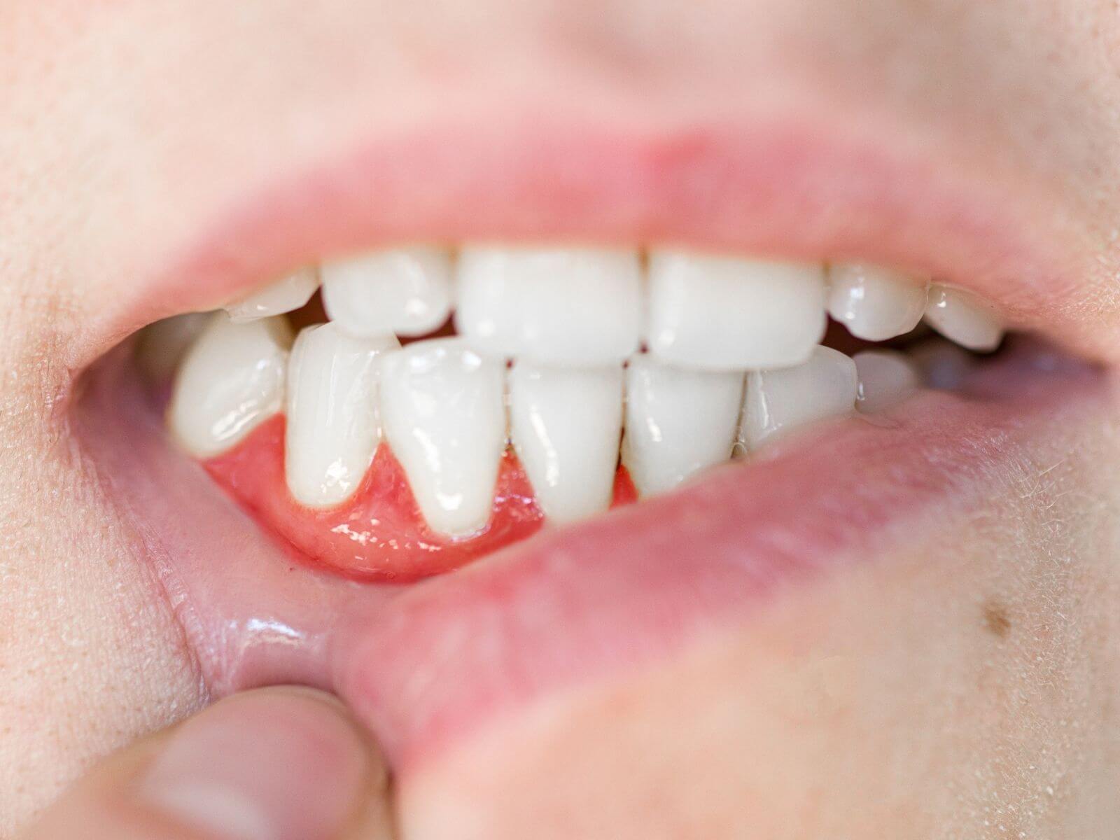 Common Causes of Gum Recession In Kids And How Parents Can Help