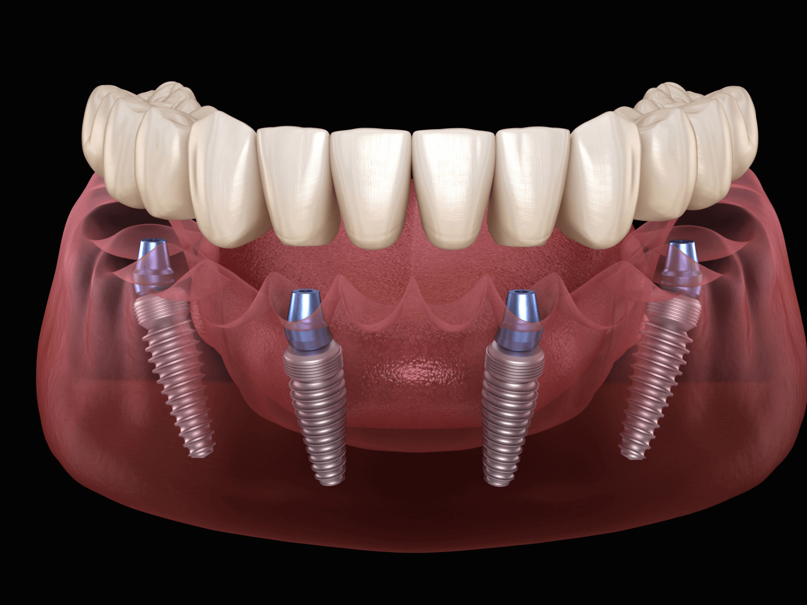 How To Prepare For Your Dental Implant Surgery
