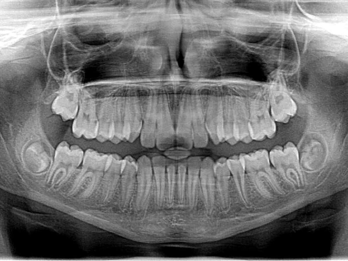 The Role of Digital X-Rays In Modern Dental Diagnosis