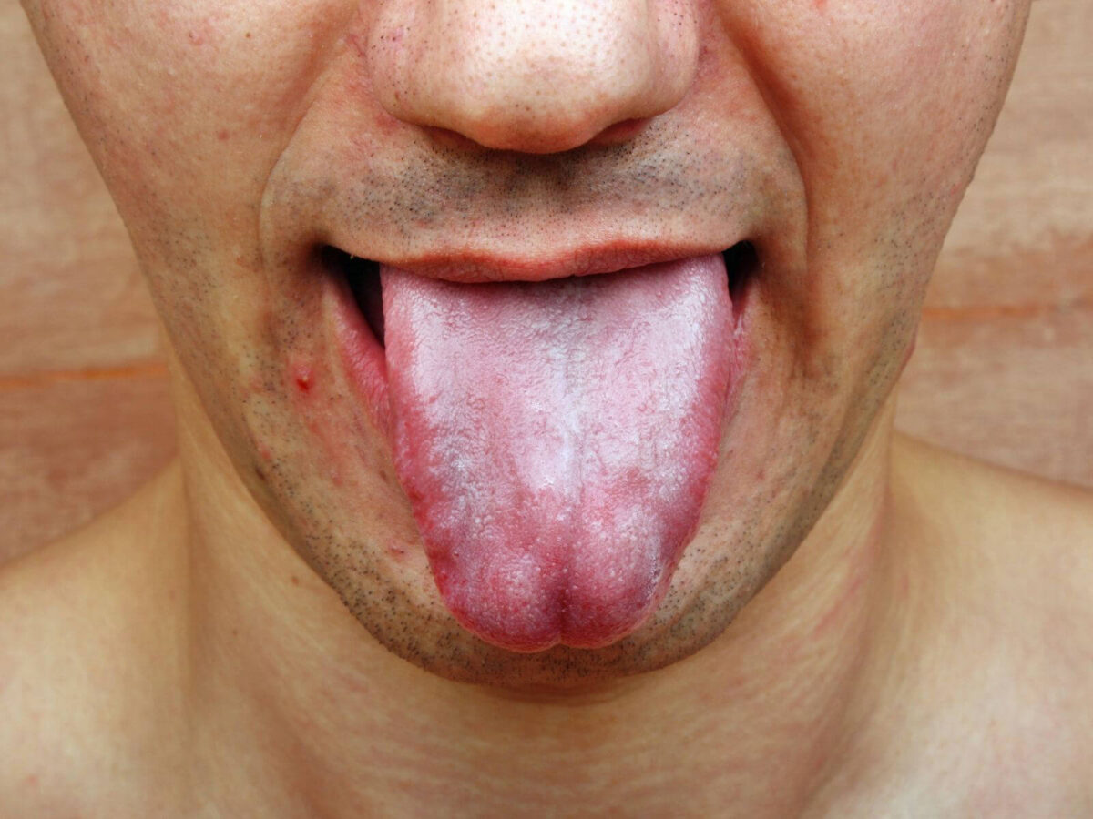 What Your Tongue Says About Your Oral Health