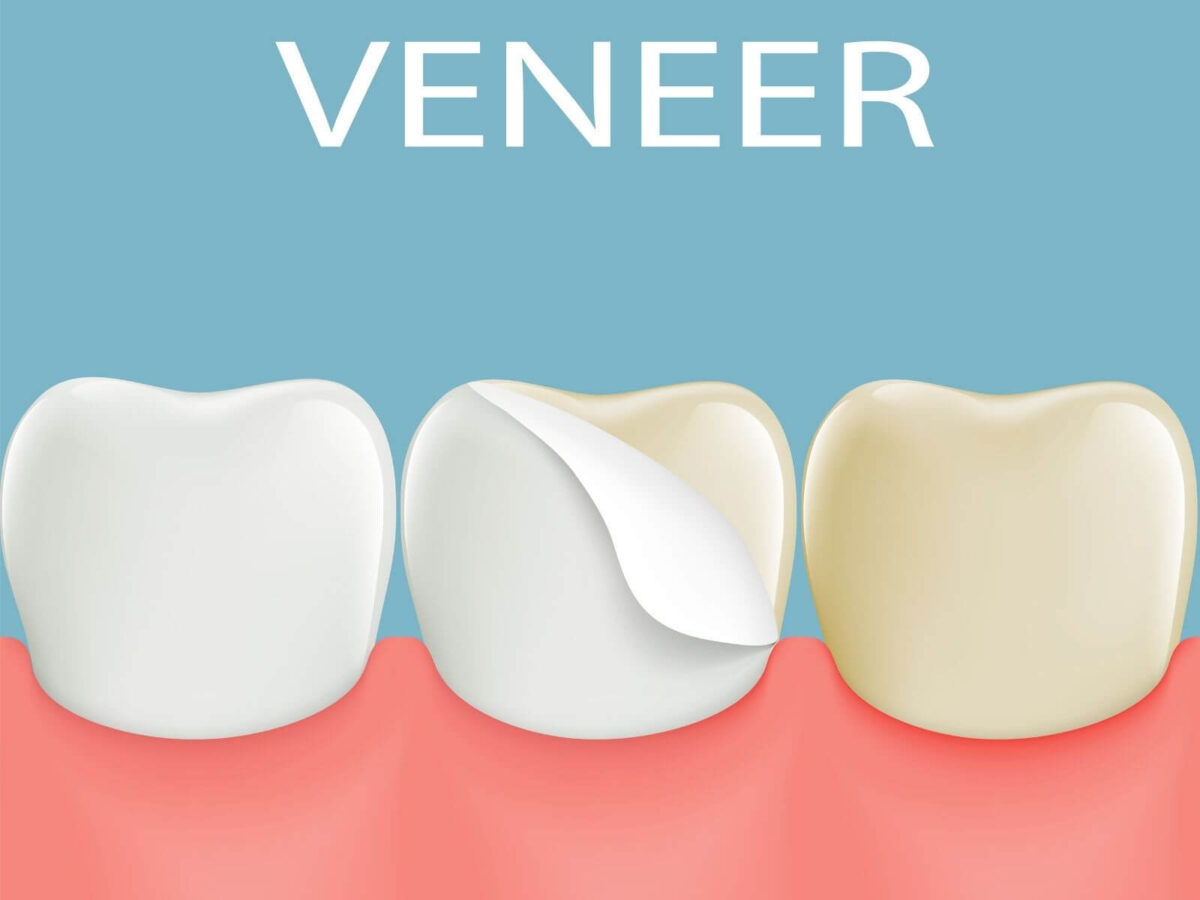 How Veneers Can Transform Your Smile In Just A Few Visits