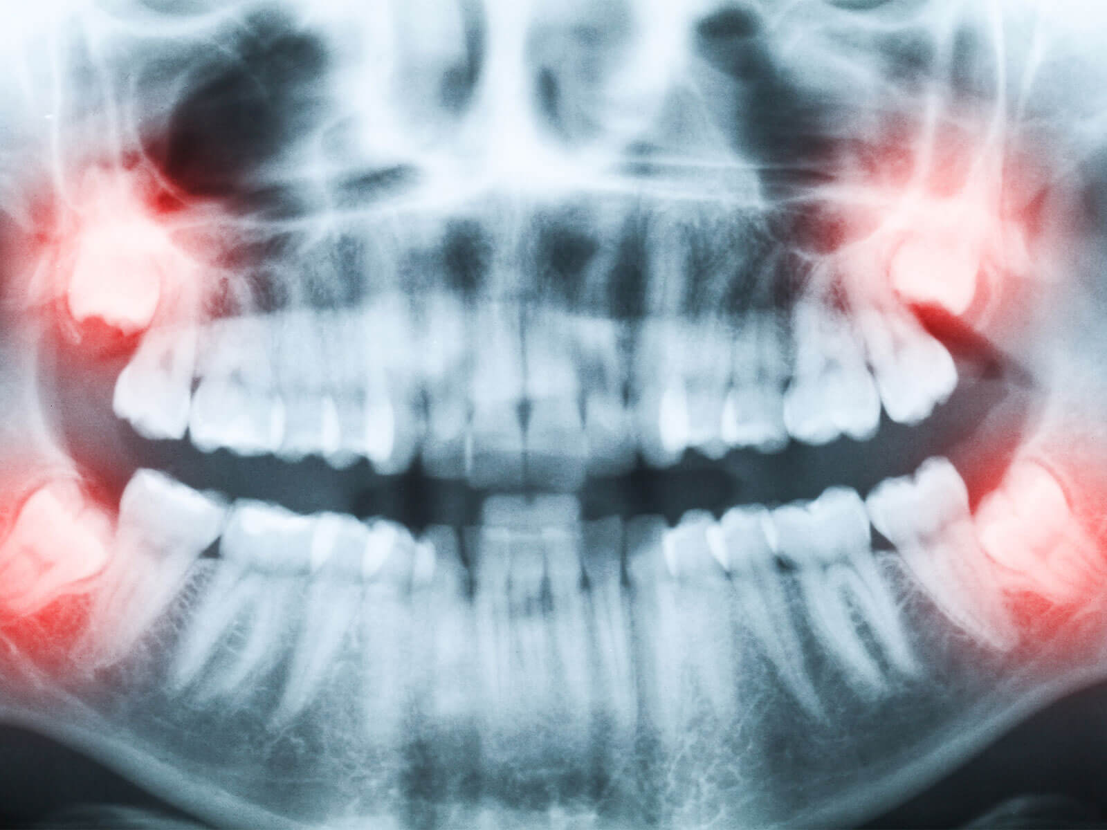 How Often Should You Get Dental X-Rays?