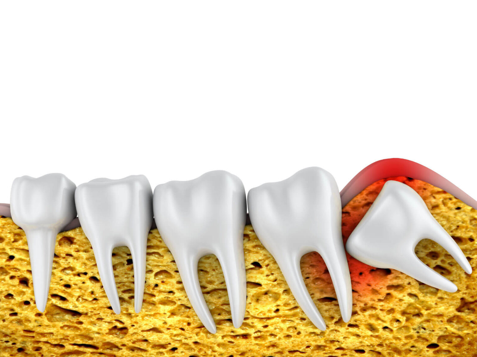 6 Signs You May Need Emergency Wisdom Tooth Removal