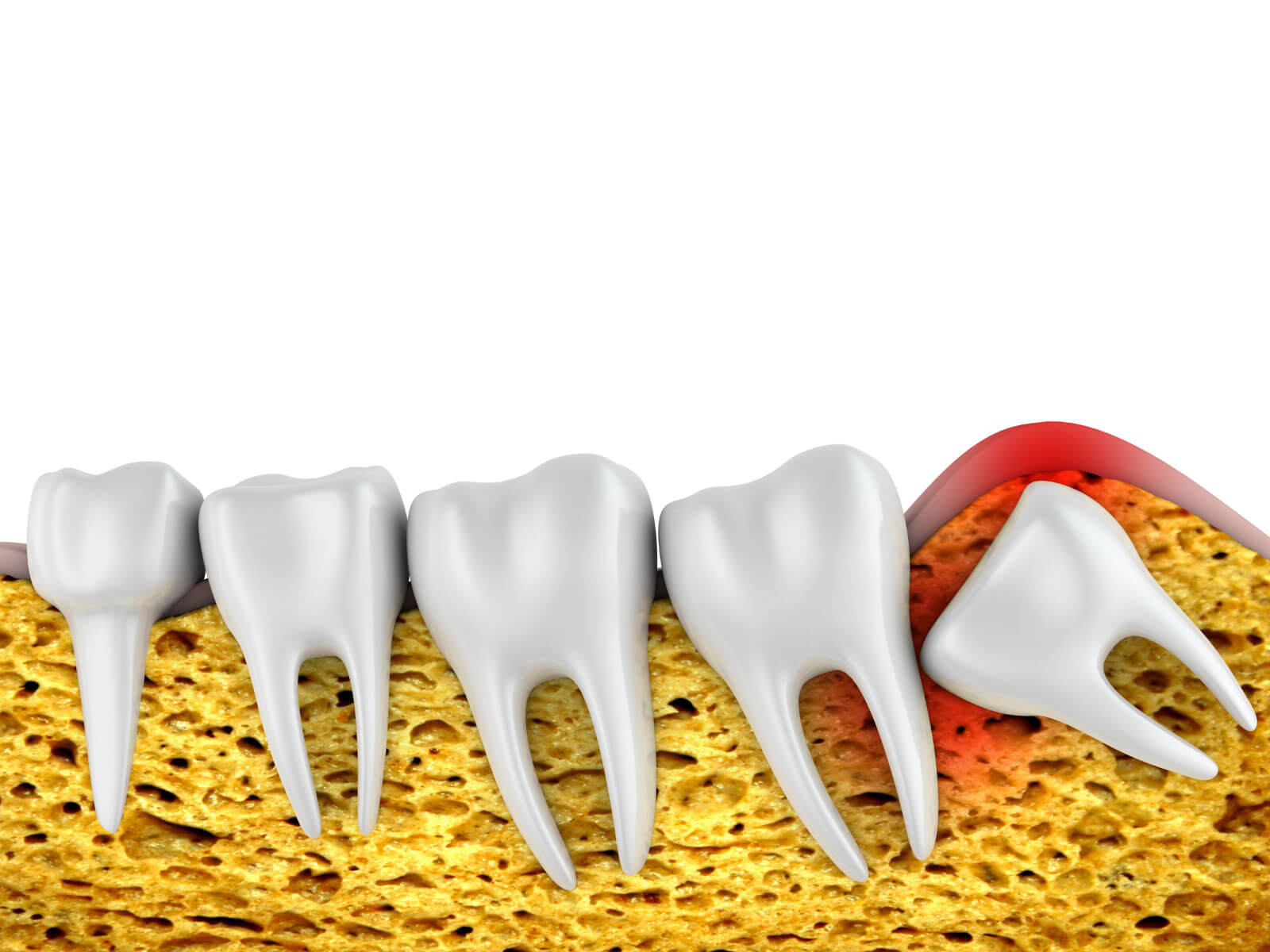 6 Signs You May Need Emergency Wisdom Tooth Removal
