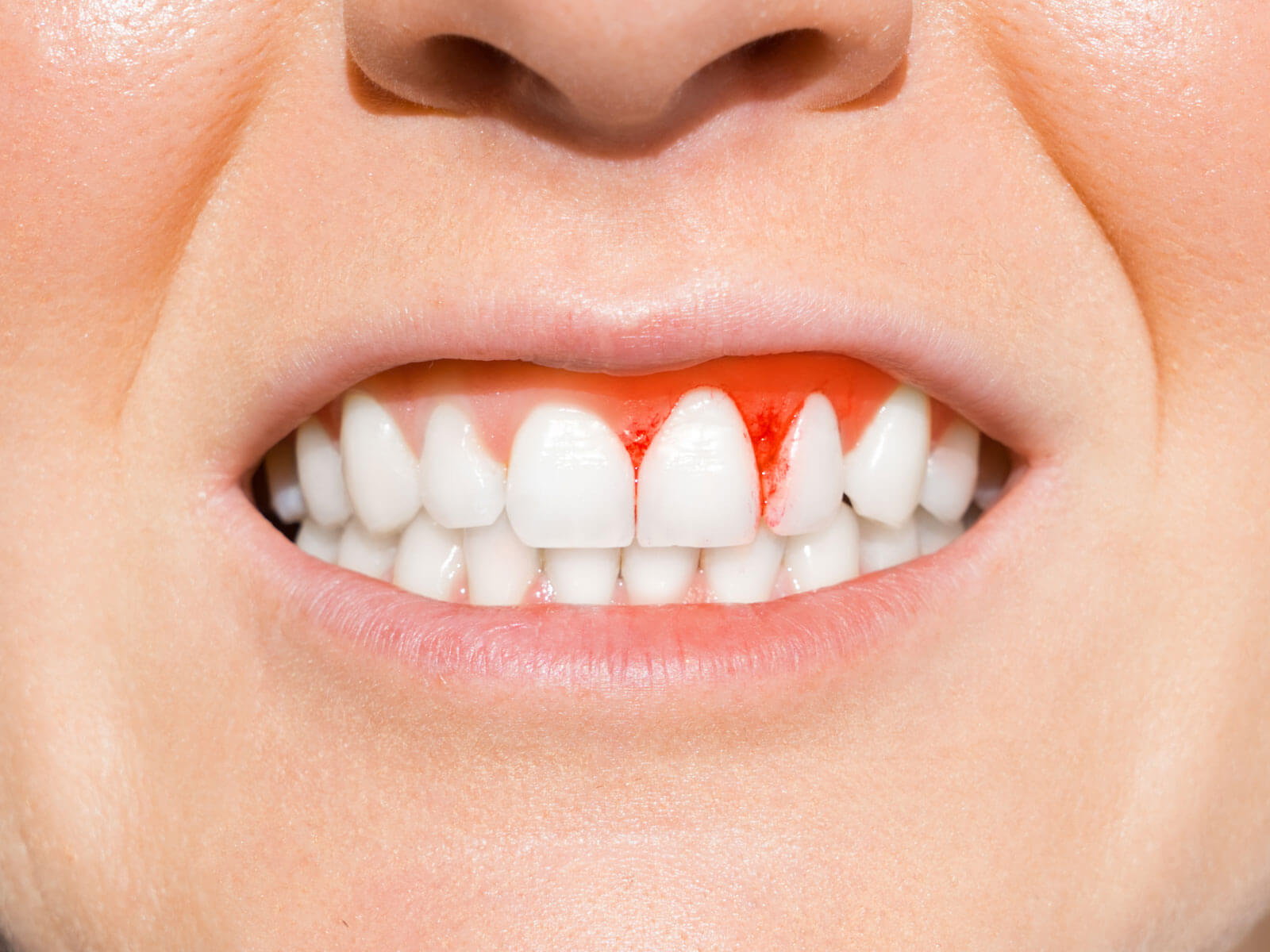 How to Stop Bleeding Gums: Causes, Home Remedies, and Treatment