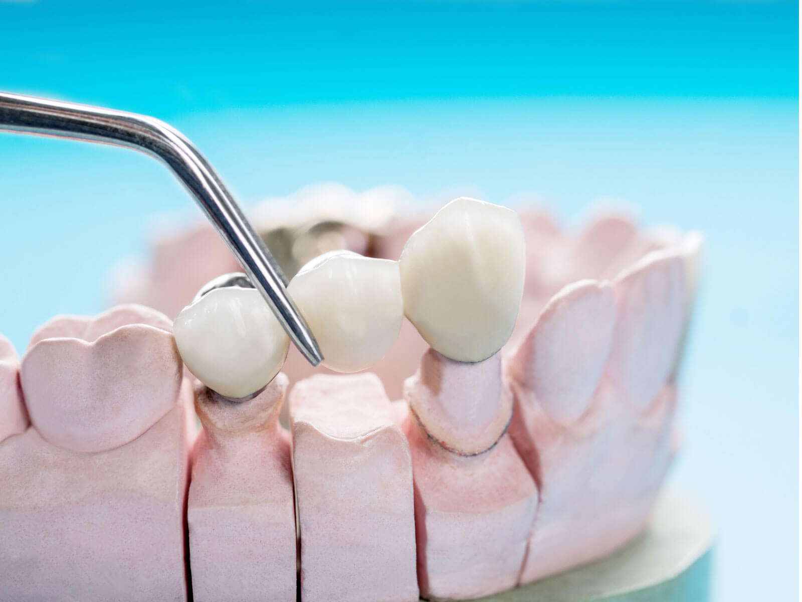 What Is a Dental Crown? Types, Uses, and What to Expect